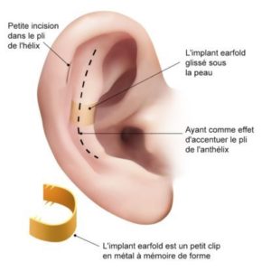EarFold™ Paris – Otoplastie médicale pour oreilles décollées - Medecine esthétique paris