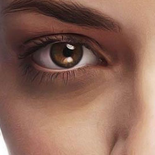 Poche sous les Yeux - Comment les enlever ? Médecine Esthétique Paris - Phoenix Esthetic