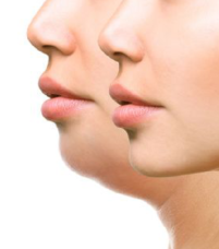 Médecine esthétique - Lipodissolution par Kybella Paris - Phoenix Esthetic