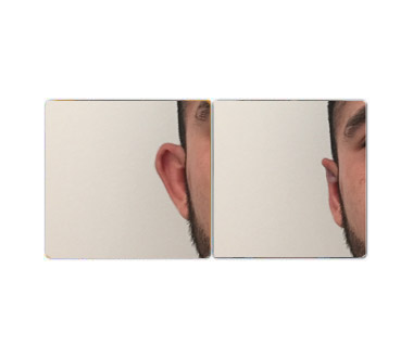 Médecine esthétique - EarFold™ – Otoplastie médicale pour oreilles décollées – Paris - Phoenix Esthetic