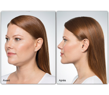 Médecine esthétique - Lipodissolution par Kybella Paris - Phoenix Esthetic