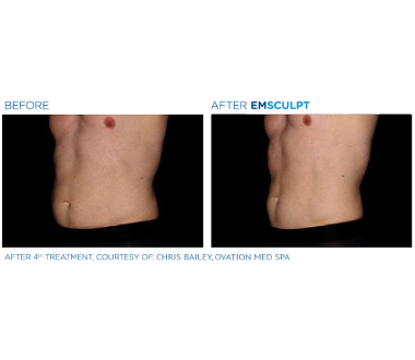 Médecine esthétique - EMSculpt Paris - Phoenix Esthetic