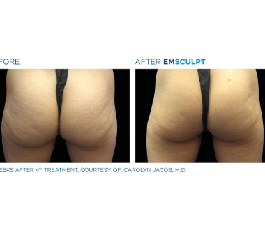 Médecine esthétique - EMSculpt Paris - Phoenix Esthetic