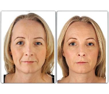 Médecine esthétique - Skinboosters Paris - Phoenix Esthetic