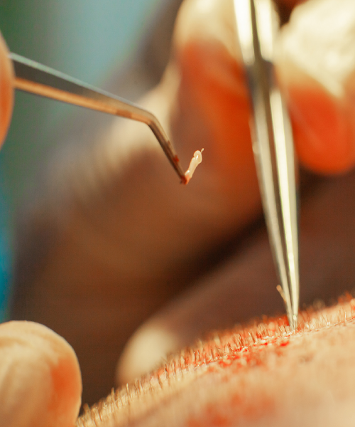 Chirurgie capillaire - Greffe de cheveux FUE - Phoenix Esthetic