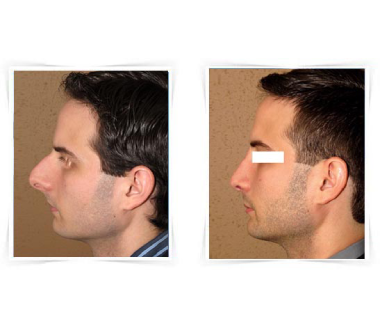 Chirurgie esthétique - Rhinoplastie  – Chirurgie du nez Paris - Phoenix Esthetic