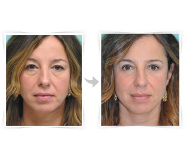 Chirurgie esthétique - Blépharoplastie – chirurgie des paupières Paris - Phoenix Esthetic