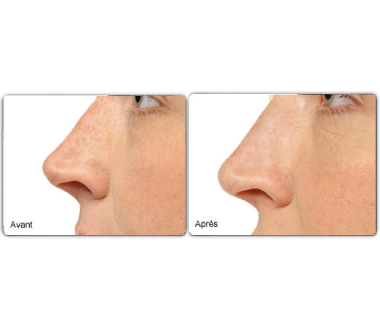 Médecine esthétique - Rhinoplastie médicale Paris - Phoenix Esthetic