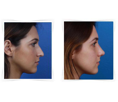 Chirurgie esthétique - Rhinoplastie  – Chirurgie du nez Paris - Phoenix Esthetic