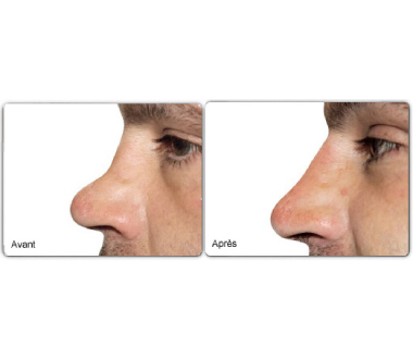 Médecine esthétique - Rhinoplastie médicale Paris - Phoenix Esthetic