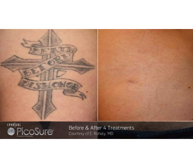 Médecine esthétique - PicoSure - Phoenix Esthetic