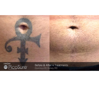 Médecine esthétique - PicoSure - Phoenix Esthetic