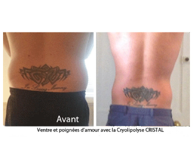 Médecine esthétique - Cryolipolyse Paris - Phoenix Esthetic