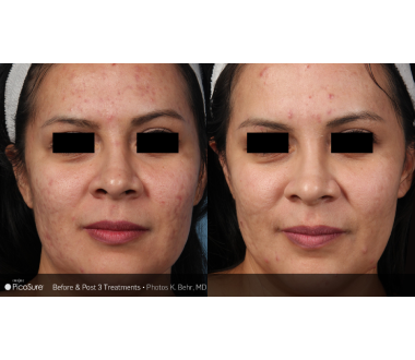 Médecine esthétique - PicoSure - Phoenix Esthetic