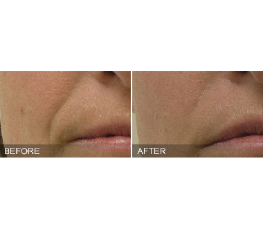 Médecine esthétique - Hydrafacial - Phoenix Esthetic