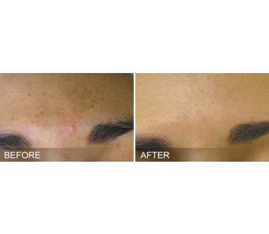 Médecine esthétique - Hydrafacial - Phoenix Esthetic