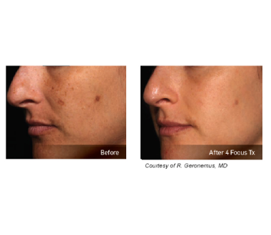 Médecine esthétique - PicoSure - Phoenix Esthetic
