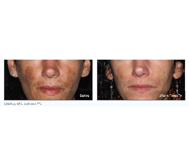 Médecine esthétique - PicoSure - Phoenix Esthetic