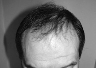 Chirurgie capillaire - Greffe de cheveux FUE - Phoenix Esthetic