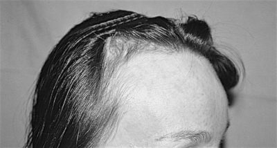 Chirurgie capillaire - Greffe de cheveux FUE - Phoenix Esthetic