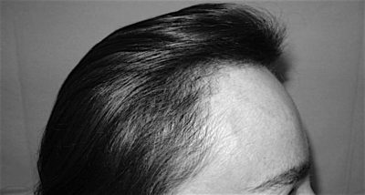 Chirurgie capillaire - Greffe de cheveux FUE - Phoenix Esthetic