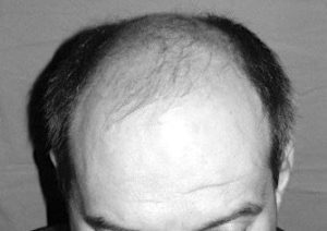Greffe de Cheveux FUE à Paris Photo avant après - Sans Cicatrices - Phoenix Esthetic