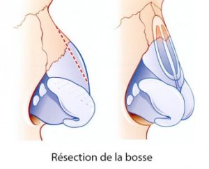 Rhinoplastie Paris photo - Chirurgie Esthétique du nez - Phoenix Esthetic 