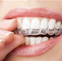 Esthetiques Dentaire - Alignement dentaire par orthodontie invisible Paris - Phoenix Esthetic