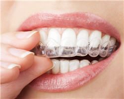 Orthodontie par aligneurs invisibles - Phoenix Esthetic Paris