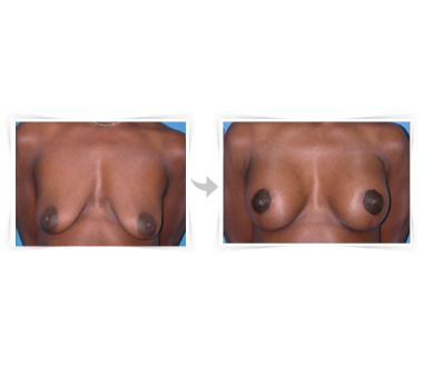 Chirurgie esthétique - Réduction mammaire Paris - Phoenix Esthetic