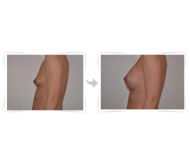 Chirurgie esthétique - Augmentation mammaire Paris - Phoenix Esthetic