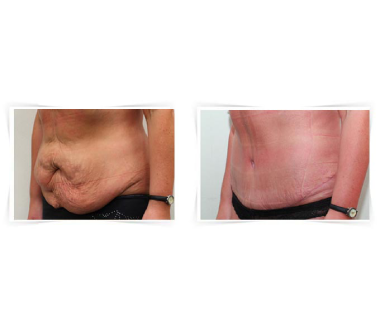 Chirurgie esthétique - Abdominoplastie Paris - Phoenix Esthetic