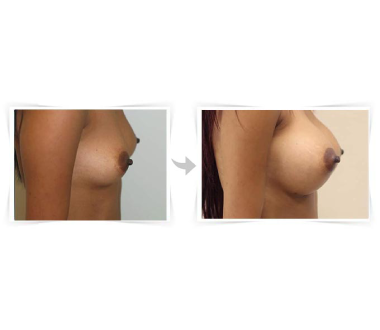 Chirurgie esthétique - Augmentation mammaire Paris - Phoenix Esthetic