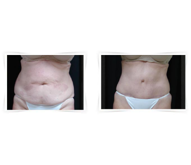 Chirurgie esthétique - Abdominoplastie Paris - Phoenix Esthetic