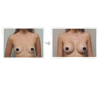 Chirurgie esthétique - Augmentation mammaire Paris - Phoenix Esthetic