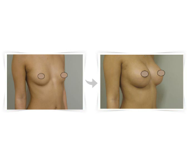 Chirurgie esthétique - Augmentation mammaire Paris - Phoenix Esthetic