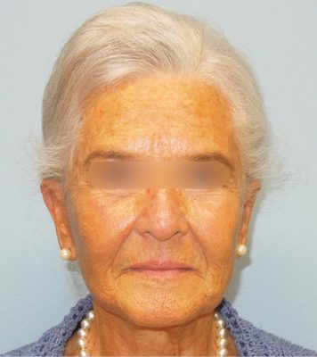 Chirurgie esthétique - Lifting facial Paris - Phoenix Esthetic
