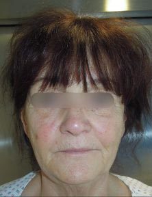 Chirurgie esthétique - Lifting facial Paris - Phoenix Esthetic