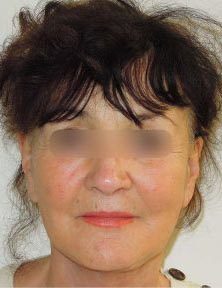 Chirurgie esthétique - Lifting facial Paris - Phoenix Esthetic