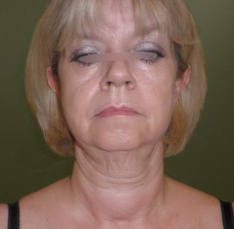 Chirurgie esthétique - Lifting facial Paris - Phoenix Esthetic