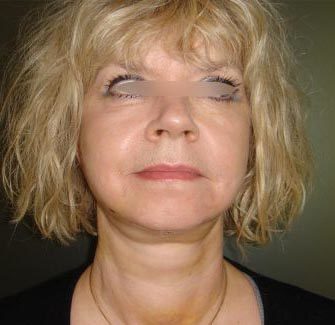 Chirurgie esthétique - Lifting facial Paris - Phoenix Esthetic
