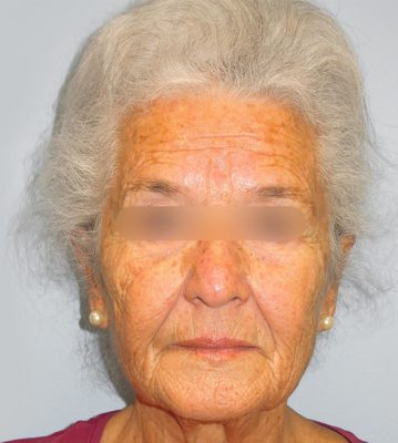 Chirurgie esthétique - Lifting facial Paris - Phoenix Esthetic