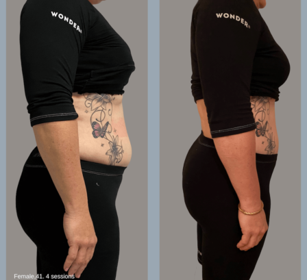 Médecine esthétique - Wonder® Paris - Phoenix Esthetic