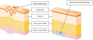 Injection Toxine Botulique à Paris - Traitement anti rides - Médecine Esthétique Paris