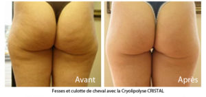 Traitement Anti Cellulite - Cellfina Paris - Cryolipolyse Paris -Médecine Esthétique Paris 8 - Phoenix Esthetic