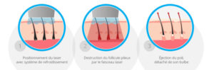 Epilation Définitive Paris : Cynosure - Candela - Phoenix Esthetic