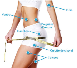 Cryolipolyse Paris - Coolsculpting - Phoenix Esthetic