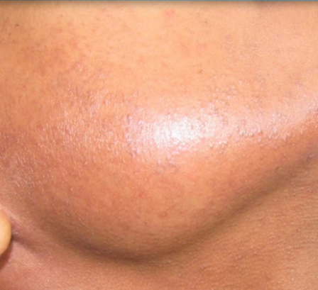 Épilation définitive - Épilation laser peaux noires Paris - Phoenix Esthetic